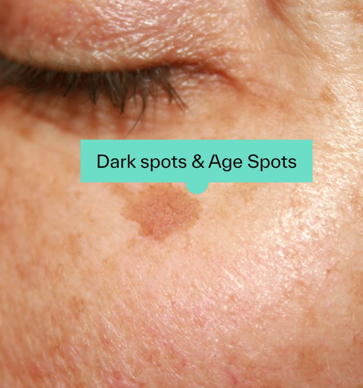 Dark Spots and age spots